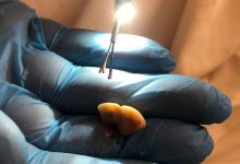 Фото - В Подмосковье хирурги извлекли кусок зубного протеза из легкого пациентки